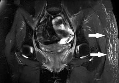 Case report: Iliac vein rupture during endovascular stenting in radiation-induced iliac venous stenosis